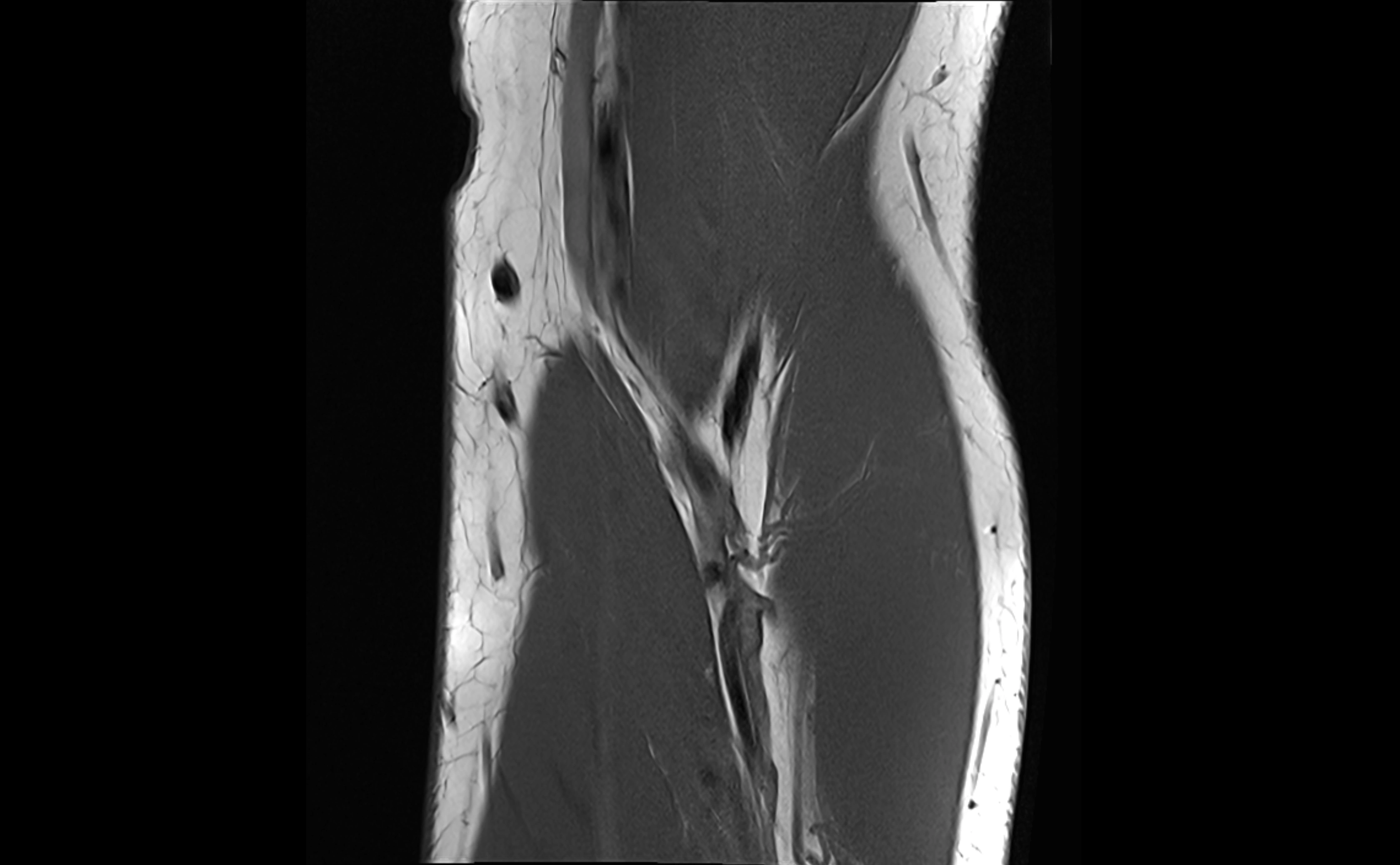 MRI elbow ligaments coronal cross sectional anatomy 3T  radiology  image-img-07001-00009.webp